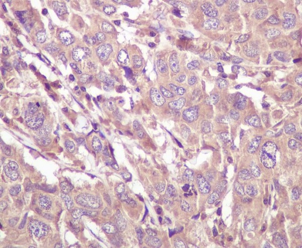 IHC analysis of Caspase 5 using anti-Caspase 5 antibody (M05259) on human breast cancer. Caspase 5 was detected in paraffin-embedded section. Heat mediated antigen retrieval was performed in citrate buffer (pH6, epitope retrieval solution) for 20 mins. The tissue section was blocked with 10% goat serum. The tissue section was then incubated with 1ug/ml rabbit anti-Caspase 5 Antibody (M05259) overnight at 4°C. Biotinylated goat anti Rabbit IgG IgG antibody was used as secondary antibody and incubated for 30 minutes at 37°C. The tissue section was developed using Strepavidin-Biotin-Complex (SABC)(Catalog # SA1022) with DAB as the chromogen.
