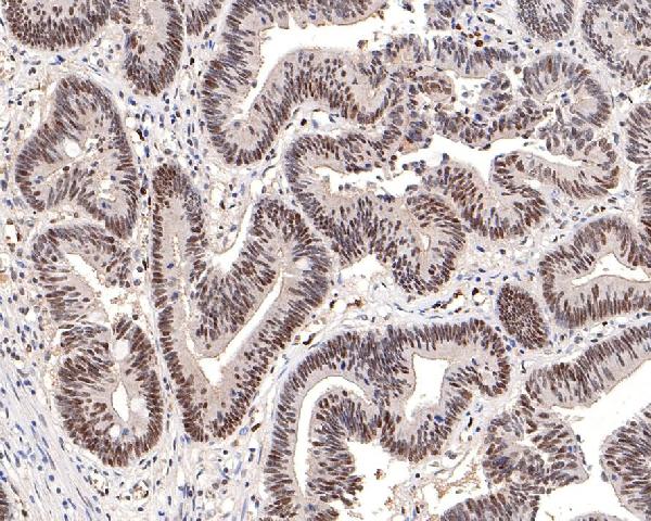 Immunohistochemical analysis of paraffin-embedded human colon carcinoma tissue using anti-Phospho-DNA PKcs (S2056) antibody. The section was pre-treated using heat mediated antigen retrieval with Tris-EDTA buffer (pH 9.0) for 20 minutes.The tissues were blocked in 5% BSA for 30 minutes at room temperature, washed with ddH2O and PBS, and then probed with the primary antibody (1/200) for 30 minutes at room temperature. The detection was performed using an HRP conjugated compact polymer system. DAB was used as the chromogen. Tissues were counterstained with hematoxylin and mounted with DPX.