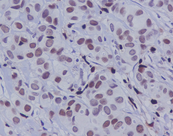 IHC analysis of Phospho-c-Jun (S63) using anti-Phospho-c-Jun (S63) antibody (P02038) on human breast carcinoma. Phospho-c-Jun (S63) was detected in paraffin-embedded section. Heat mediated antigen retrieval was performed in citrate buffer (pH6, epitope retrieval solution) for 20 mins. The tissue section was blocked with 10% goat serum. The tissue section was then incubated with 1ug/ml rabbit anti-Phospho-c-Jun (S63) Antibody (P02038) overnight at 4°C. Biotinylated goat anti-rabbit IgG was used as secondary antibody and incubated for 30 minutes at 37°C. The tissue section was developed using Strepavidin-Biotin-Complex (SABC)(Catalog # SA1022) with DAB as the chromogen.