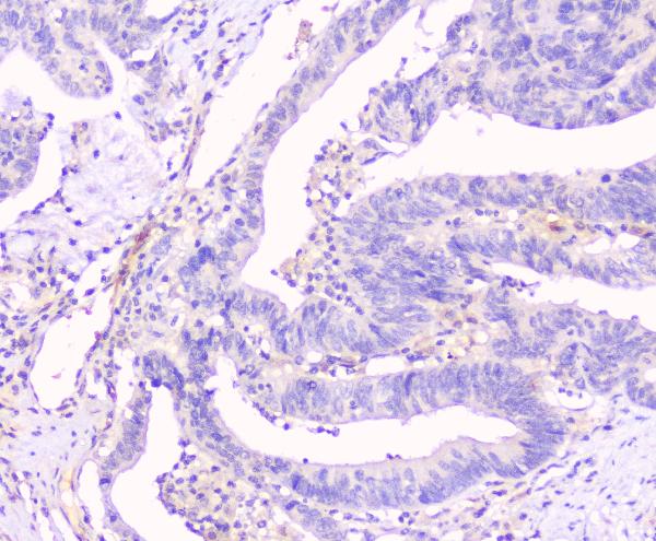 IHC analysis of Connexin 43/GJA1 using anti-Connexin 43/GJA1 antibody (PA1026-1). Connexin 43/GJA1 was detected in paraffin-embedded section of human intestinal cancer tissues. Heat mediated antigen retrieval was performed in citrate buffer (pH6, epitope retrieval solution) for 20 mins. The tissue section was blocked with 10% goat serum. The tissue section was then incubated with 1μg/ml rabbit anti-Connexin 43/GJA1 Antibody (PA1026-1) overnight at 4°C. Biotinylated goat anti-rabbit IgG was used as secondary antibody and incubated for 30 minutes at 37°C. The tissue section was developed using Strepavidin-Biotin-Complex (SABC)(Catalog # SA1022) with DAB as the chromogen.