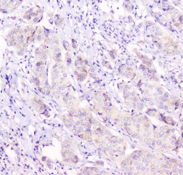 IHC analysis of Connexin 43/GJA1 using anti-Connexin 43/GJA1 antibody (PA1026-1). Connexin 43/GJA1 was detected in paraffin-embedded section of human mammary cancer tissues. Heat mediated antigen retrieval was performed in citrate buffer (pH6, epitope retrieval solution) for 20 mins. The tissue section was blocked with 10% goat serum. The tissue section was then incubated with 1μg/ml rabbit anti-Connexin 43/GJA1 Antibody (PA1026-1) overnight at 4°C. Biotinylated goat anti-rabbit IgG was used as secondary antibody and incubated for 30 minutes at 37°C. The tissue section was developed using Strepavidin-Biotin-Complex (SABC)(Catalog # SA1022) with DAB as the chromogen.