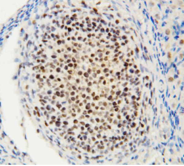 IHC analysis of MTA1 using anti-MTA1 antibody (PA1483). MTA1 was detected in paraffin-embedded section of rat ovary tissue. Heat mediated antigen retrieval was performed in citrate buffer (pH6, epitope retrieval solution) for 20 mins. The tissue section was blocked with 10% goat serum. The tissue section was then incubated with 1μg/ml rabbit anti-MTA1 Antibody (PA1483) overnight at 4°C. Biotinylated goat anti-rabbit IgG was used as secondary antibody and incubated for 30 minutes at 37°C. The tissue section was developed using Strepavidin-Biotin-Complex (SABC)(Catalog # SA1022) with DAB as the chromogen.