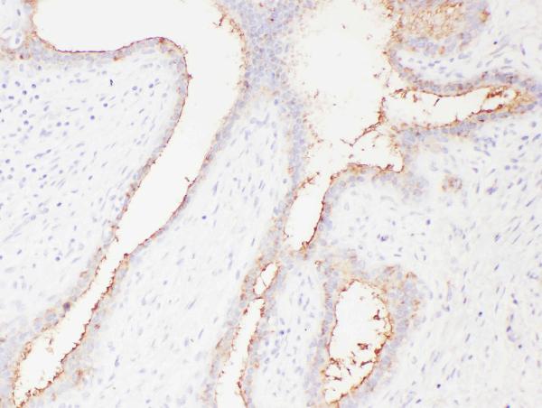 IHC analysis of SLC22A6 using anti-SLC22A6 antibody (PA1683). SLC22A6 was detected in paraffin-embedded section of human mammary cancer tissues. Heat mediated antigen retrieval was performed in citrate buffer (pH6, epitope retrieval solution) for 20 mins. The tissue section was blocked with 10% goat serum. The tissue section was then incubated with 1μg/ml rabbit anti-SLC22A6 Antibody (PA1683) overnight at 4°C. Biotinylated goat anti-rabbit IgG was used as secondary antibody and incubated for 30 minutes at 37°C. The tissue section was developed using Strepavidin-Biotin-Complex (SABC)(Catalog # SA1022) with DAB as the chromogen.