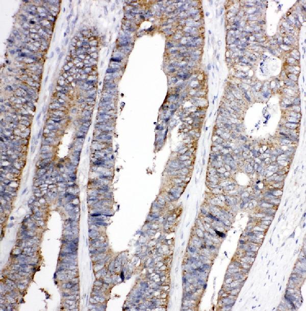 Anti-TRPC3 antibody, PA1753, IHC(P) IHC(P): Human Rectal Cancer Tissue