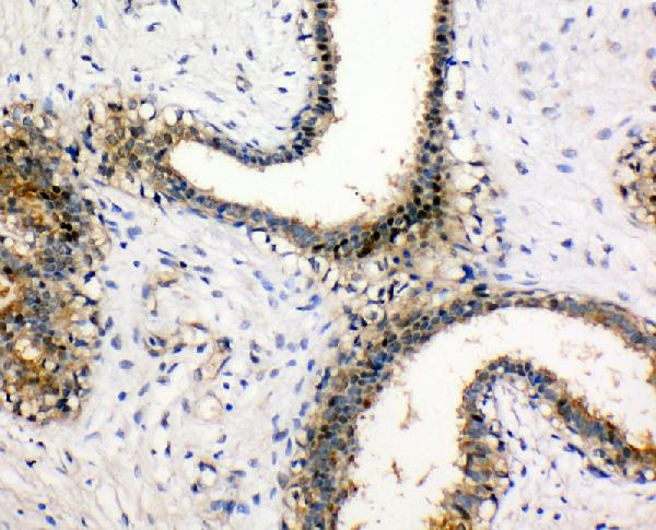 IHC analysis of NM23A using anti-NM23A antibody (PA1829). NM23A was detected in paraffin-embedded section of human mammary cancer tissue. Heat mediated antigen retrieval was performed in citrate buffer (pH6, epitope retrieval solution) for 20 mins. The tissue section was blocked with 10% goat serum. The tissue section was then incubated with 1μg/ml rabbit anti-NM23A Antibody (PA1829) overnight at 4°C. Biotinylated goat anti-rabbit IgG was used as secondary antibody and incubated for 30 minutes at 37°C. The tissue section was developed using Strepavidin-Biotin-Complex (SABC)(Catalog # SA1022) with DAB as the chromogen.