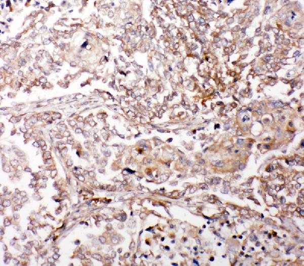 IHC analysis of Glutaredoxin 2 using anti-Glutaredoxin 2 antibody (PA1885). Glutaredoxin 2 was detected in paraffin-embedded section of human lung cancer tissue. Heat mediated antigen retrieval was performed in citrate buffer (pH6, epitope retrieval solution) for 20 mins. The tissue section was blocked with 10% goat serum. The tissue section was then incubated with 1μg/ml rabbit anti-Glutaredoxin 2 Antibody (PA1885) overnight at 4°C. Biotinylated goat anti-rabbit IgG was used as secondary antibody and incubated for 30 minutes at 37°C. The tissue section was developed using Strepavidin-Biotin-Complex (SABC)(Catalog # SA1022) with DAB as the chromogen.