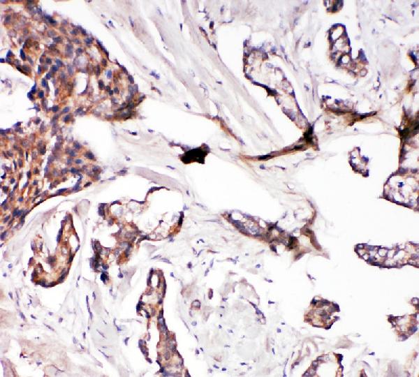 IHC analysis of Glutaredoxin 2 using anti-Glutaredoxin 2 antibody (PA1885). Glutaredoxin 2 was detected in paraffin-embedded section of human mammary cancer tissue. Heat mediated antigen retrieval was performed in citrate buffer (pH6, epitope retrieval solution) for 20 mins. The tissue section was blocked with 10% goat serum. The tissue section was then incubated with 1μg/ml rabbit anti-Glutaredoxin 2 Antibody (PA1885) overnight at 4°C. Biotinylated goat anti-rabbit IgG was used as secondary antibody and incubated for 30 minutes at 37°C. The tissue section was developed using Strepavidin-Biotin-Complex (SABC)(Catalog # SA1022) with DAB as the chromogen.