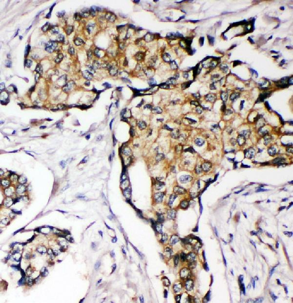 IHC analysis of SOD3 using anti-SOD3 antibody (PA1899). SOD3 was detected in paraffin-embedded section of human mammary cancer tissue. Heat mediated antigen retrieval was performed in citrate buffer (pH6, epitope retrieval solution) for 20 mins. The tissue section was blocked with 10% goat serum. The tissue section was then incubated with 1μg/ml rabbit anti-SOD3 Antibody (PA1899) overnight at 4°C. Biotinylated goat anti-rabbit IgG was used as secondary antibody and incubated for 30 minutes at 37°C. The tissue section was developed using Strepavidin-Biotin-Complex (SABC)(Catalog # SA1022) with DAB as the chromogen.