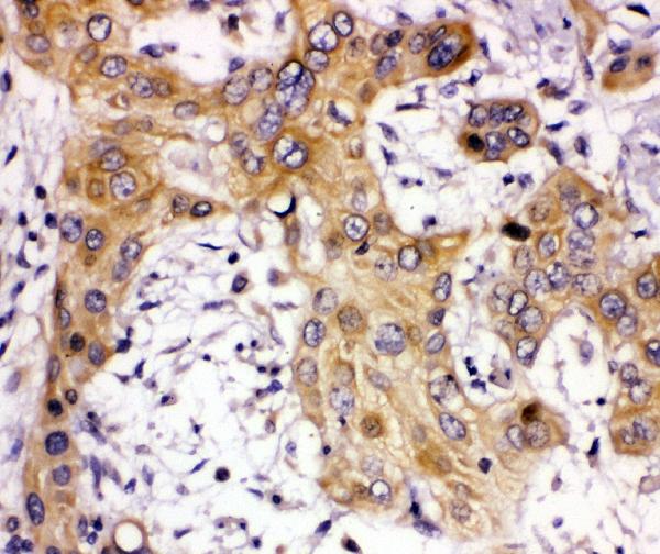 IHC analysis of ZEB2 using anti-ZEB2 antibody (PA1959). ZEB2 was detected in paraffin-embedded section of human glioma tissue. Heat mediated antigen retrieval was performed in citrate buffer (pH6, epitope retrieval solution) for 20 mins. The tissue section was blocked with 10% goat serum. The tissue section was then incubated with 1μg/ml rabbit anti-ZEB2 Antibody (PA1959) overnight at 4°C. Biotinylated goat anti-rabbit IgG was used as secondary antibody and incubated for 30 minutes at 37°C. The tissue section was developed using Strepavidin-Biotin-Complex (SABC)(Catalog # SA1022) with DAB as the chromogen.