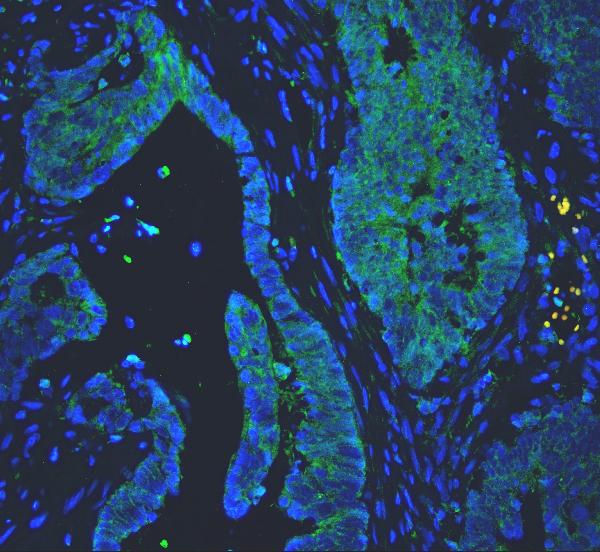 IF analysis of PC1/3/PCSK1 using anti-PC1/3/PCSK1 antibody (PA2084) PC1/3/PCSK1 was detected in paraffin-embedded section of human colon cancer tissues. Heat mediated antigen retrieval was performed in citrate buffer (pH6, epitope retrieval solution ) for 20 mins. The tissue section was blocked with 10% goat serum. The tissue section was then incubated with 1μg/mL rabbit anti-PC1/3/PCSK1 Antibody (PA2084) overnight at 4°C. Biotin conjugated goat anti-rabbit IgG (BA1003) was used as secondary antibody and incubated for 30 minutes at 37°C. The tissue section was developed using DyLight®488 Conjugated Avidin (BA1128). The section was counterstained with DAPI. Visualize using a fluorescence microscope and filter sets appropriate for the label used.