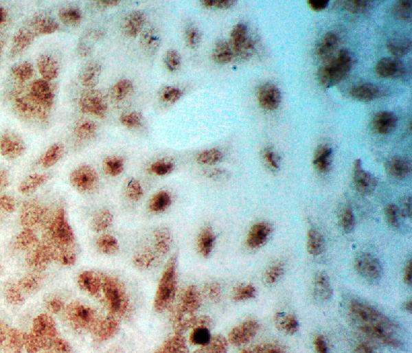 ICC analysis of PLK2 using anti-PLK2 antibody (PA2131). PLK2 was detected in immunocytochemical section of A549 cell. Enzyme antigen retrieval was performed using IHC enzyme antigen retrieval reagent (AR0022) for 15 mins. The cells were blocked with 10% goat serum. And then incubated with 1μg/ml rabbit anti-PLK2 Antibody (PA2131) overnight at 4°C. Biotinylated goat anti-rabbit IgG was used as secondary antibody and incubated for 30 minutes at 37°C. The section was developed using Strepavidin-Biotin-Complex (SABC)(Catalog # SA1022) with DAB as the chromogen.