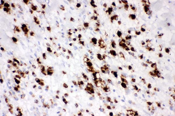 IHC analysis of Mucin 5AC using anti-Mucin 5AC antibody (PA2303). Mucin 5AC was detected in paraffin-embedded section of human gastric cancer tissue. Heat mediated antigen retrieval was performed in citrate buffer (pH6, epitope retrieval solution) for 20 mins. The tissue section was blocked with 10% goat serum. The tissue section was then incubated with 1μg/ml rabbit anti-Mucin 5AC Antibody (PA2303) overnight at 4°C. Biotinylated goat anti-rabbit IgG was used as secondary antibody and incubated for 30 minutes at 37°C. The tissue section was developed using Strepavidin-Biotin-Complex (SABC)(Catalog # SA1022) with DAB as the chromogen.