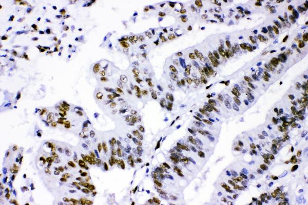 IHC analysis of PML using anti-PML antibody (PB10084).