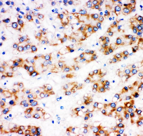 IHC analysis of AFP using anti-AFP antibody (PB9090).