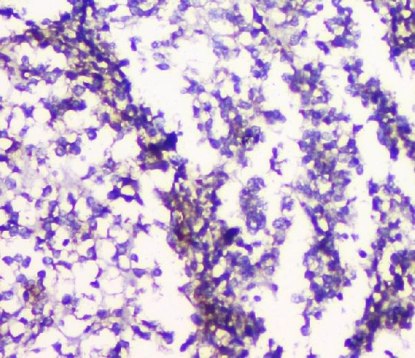 IHC analysis of 5HT2A Receptor using anti-5HT2A Receptor antibody (PB9599). 5HT2A Receptor was detected in paraffin-embedded section of human glioma tissues. Heat mediated antigen retrieval was performed in citrate buffer (pH6, epitope retrieval solution) for 20 mins. The tissue section was blocked with 10% goat serum. The tissue section was then incubated with 1μg/ml rabbit anti-5HT2A Receptor Antibody (PB9599) overnight at 4°C. Biotinylated goat anti-rabbit IgG was used as secondary antibody and incubated for 30 minutes at 37°C. The tissue section was developed using Strepavidin-Biotin-Complex (SABC)(Catalog # SA1022) with DAB as the chromogen.