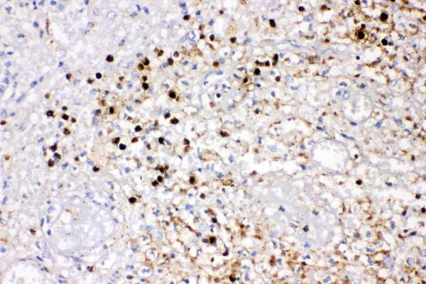 IHC analysis of IL-8 using anti-IL-8 antibody (PB9621). IL-8 was detected in paraffin-embedded section of human appendicitis tissues. Heat mediated antigen retrieval was performed in citrate buffer (pH6, epitope retrieval solution) for 20 mins. The tissue section was blocked with 10% goat serum. The tissue section was then incubated with 1μg/ml rabbit anti-IL-8 Antibody (PB9621) overnight at 4°C. Biotinylated goat anti-rabbit IgG was used as secondary antibody and incubated for 30 minutes at 37°C. The tissue section was developed using Strepavidin-Biotin-Complex (SABC)(Catalog # SA1022) with DAB as the chromogen.