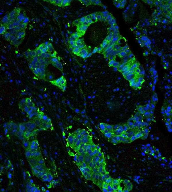 IF analysis of HSP90AB1 using anti-HSP90AB1 antibody (PB9636) HSP90AB1 was detected in paraffin-embedded section of human lung cancer tissues. Heat mediated antigen retrieval was performed in citrate buffer (pH6, epitope retrieval solution ) for 20 mins. The tissue section was blocked with 10% goat serum. The tissue section was then incubated with 2μg/mL rabbit anti-HSP90AB1 Antibody (PB9636) overnight at 4°C. DyLight®488 Conjugated Goat Anti-Rabbit IgG (BA1127) was used as secondary antibody at 1:100 dilution and incubated for 30 minutes at 37°C. The section was counterstained with DAPI. Visualize using a fluorescence microscope and filter sets appropriate for the label used.