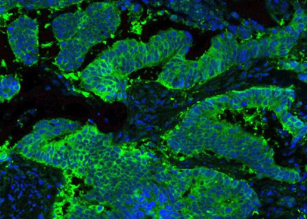 IF analysis of HSP90AB1 using anti-HSP90AB1 antibody (PB9636) HSP90AB1 was detected in paraffin-embedded section of human lung cancer tissues. Heat mediated antigen retrieval was performed in citrate buffer (pH6, epitope retrieval solution ) for 20 mins. The tissue section was blocked with 10% goat serum. The tissue section was then incubated with 2μg/mL rabbit anti-HSP90AB1 Antibody (PB9636) overnight at 4°C. DyLight®488 Conjugated Goat Anti-Rabbit IgG (BA1127) was used as secondary antibody at 1:100 dilution and incubated for 30 minutes at 37°C. The section was counterstained with DAPI. Visualize using a fluorescence microscope and filter sets appropriate for the label used.