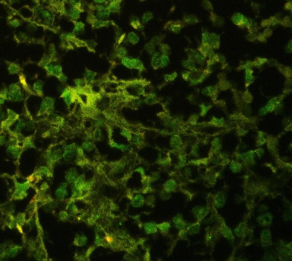 IF analysis of ELAVL4 using anti-ELAVL4 antibody (PB9698) ELAVL4 was detected in paraffin-embedded section of human glioma tissues. Heat mediated antigen retrieval was performed in citrate buffer (pH6, epitope retrieval solution ) for 20 mins. The tissue section was blocked with 10% goat serum. The tissue section was then incubated with 1μg/mL rabbit anti-ELAVL4 Antibody (PB9698) overnight at 4°C. DyLight®488 Conjugated Goat Anti-Rabbit IgG (BA1127) was used as secondary antibody at 1:100 dilution and incubated for 30 minutes at 37°C. Visualize using a fluorescence microscope and filter sets appropriate for the label used.