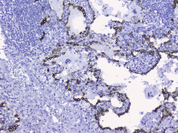 IHC analysis of KRT19 using anti-KRT19 antibody (PB9715). KRT19 was detected in paraffin-embedded section of human lung cancer tissues. Heat mediated antigen retrieval was performed in citrate buffer (pH6, epitope retrieval solution) for 20 mins. The tissue section was blocked with 10% goat serum. The tissue section was then incubated with 2μg/ml rabbit anti-KRT19 Antibody (PB9715) overnight at 4°C. Biotinylated goat anti-rabbit IgG was used as secondary antibody and incubated for 30 minutes at 37°C. The tissue section was developed using Strepavidin-Biotin-Complex (SABC)(Catalog # SA1022) with DAB as the chromogen.