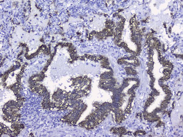 IHC analysis of KRT19 using anti-KRT19 antibody (PB9715). KRT19 was detected in paraffin-embedded section of human lung cancer tissues. Heat mediated antigen retrieval was performed in citrate buffer (pH6, epitope retrieval solution) for 20 mins. The tissue section was blocked with 10% goat serum. The tissue section was then incubated with 2μg/ml rabbit anti-KRT19 Antibody (PB9715) overnight at 4°C. Biotinylated goat anti-rabbit IgG was used as secondary antibody and incubated for 30 minutes at 37°C. The tissue section was developed using Strepavidin-Biotin-Complex (SABC)(Catalog # SA1022) with DAB as the chromogen.