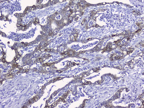 IHC analysis of KRT19 using anti-KRT19 antibody (PB9715). KRT19 was detected in paraffin-embedded section of human intestinal cancer tissues. Heat mediated antigen retrieval was performed in citrate buffer (pH6, epitope retrieval solution) for 20 mins. The tissue section was blocked with 10% goat serum. The tissue section was then incubated with 2μg/ml rabbit anti-KRT19 Antibody (PB9715) overnight at 4°C. Biotinylated goat anti-rabbit IgG was used as secondary antibody and incubated for 30 minutes at 37°C. The tissue section was developed using Strepavidin-Biotin-Complex (SABC)(Catalog # SA1022) with DAB as the chromogen.