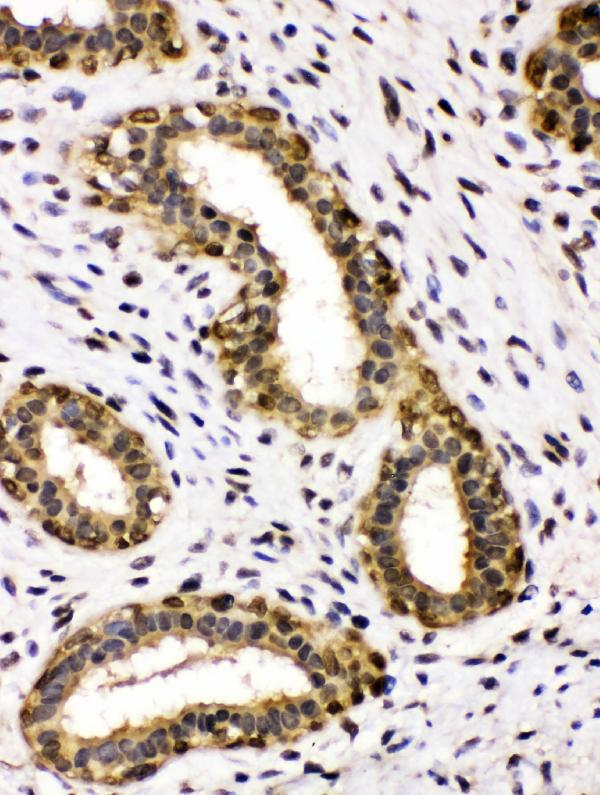 IHC analysis of ADH5 using anti-ADH5 antibody (RP1111). ADH5 was detected in paraffin-embedded section of human mammary cancer tissues. Heat mediated antigen retrieval was performed in citrate buffer (pH6, epitope retrieval solution) for 20 mins. The tissue section was blocked with 10% goat serum. The tissue section was then incubated with 1μg/ml rabbit anti-ADH5 Antibody (RP1111) overnight at 4°C. Biotinylated goat anti-rabbit IgG was used as secondary antibody and incubated for 30 minutes at 37°C. The tissue section was developed using Strepavidin-Biotin-Complex (SABC)(Catalog # SA1022) with DAB as the chromogen.