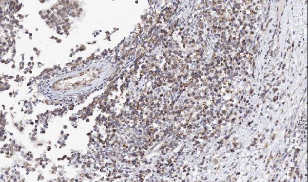 IHC analysis of AZIN2 using anti-AZIN2 antibody (RP1112). AZIN2 was detected in paraffin-embedded section of human testicar cancer tissues. Heat mediated antigen retrieval was performed in citrate buffer (pH6, epitope retrieval solution) for 20 mins. The tissue section was blocked with 10% goat serum. The tissue section was then incubated with 1μg/ml rabbit anti-AZIN2 Antibody (RP1112) overnight at 4°C. Biotinylated goat anti-rabbit IgG was used as secondary antibody and incubated for 30 minutes at 37°C. The tissue section was developed using Strepavidin-Biotin-Complex (SABC)(Catalog # SA1022) with DAB as the chromogen.